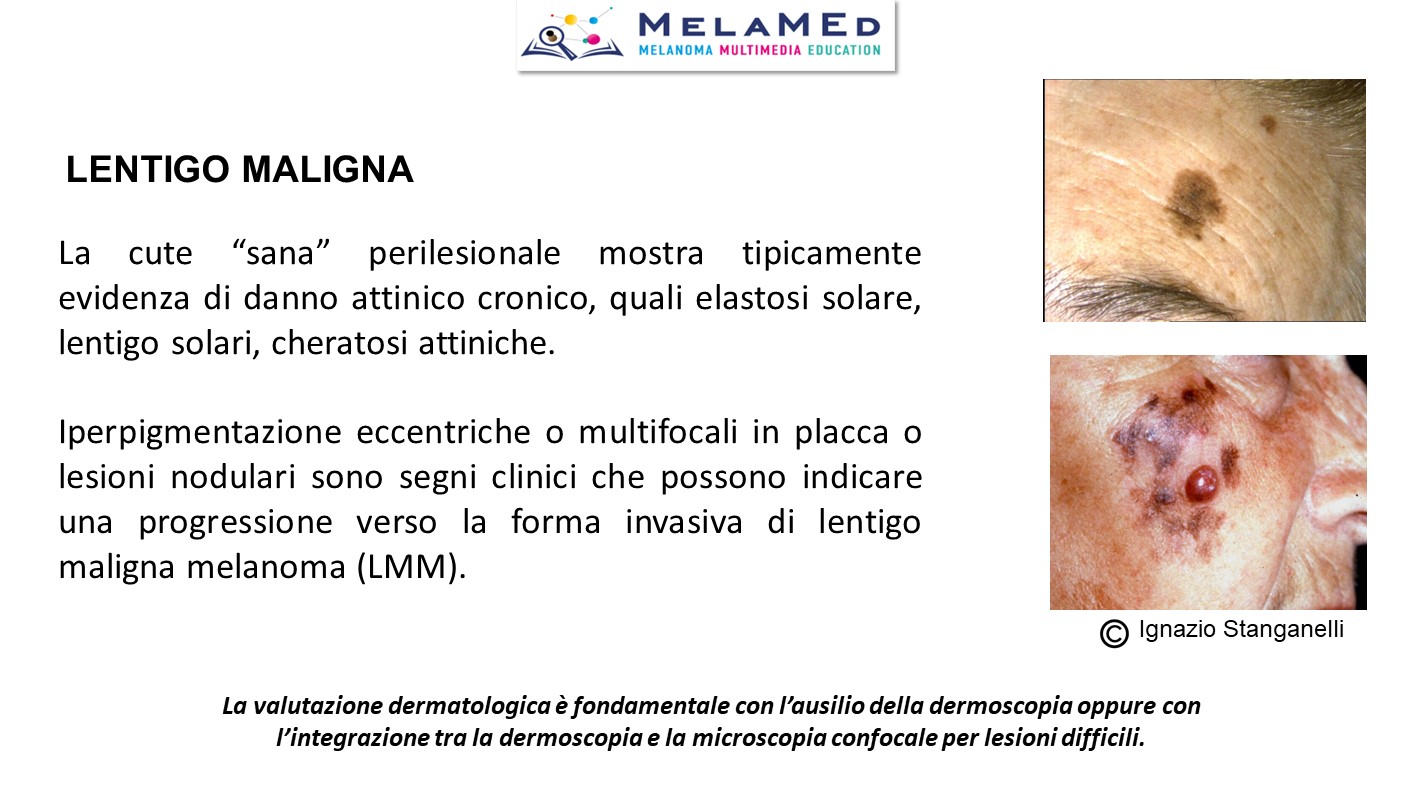 Caso clinico 4 Pizzichetta (14)