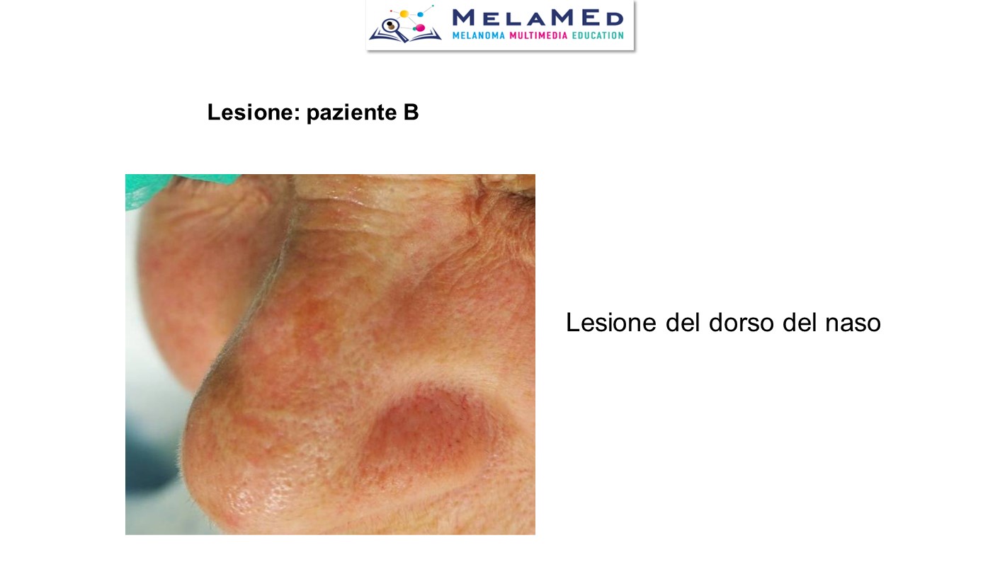 Caso clinico 4 Pizzichetta (15)