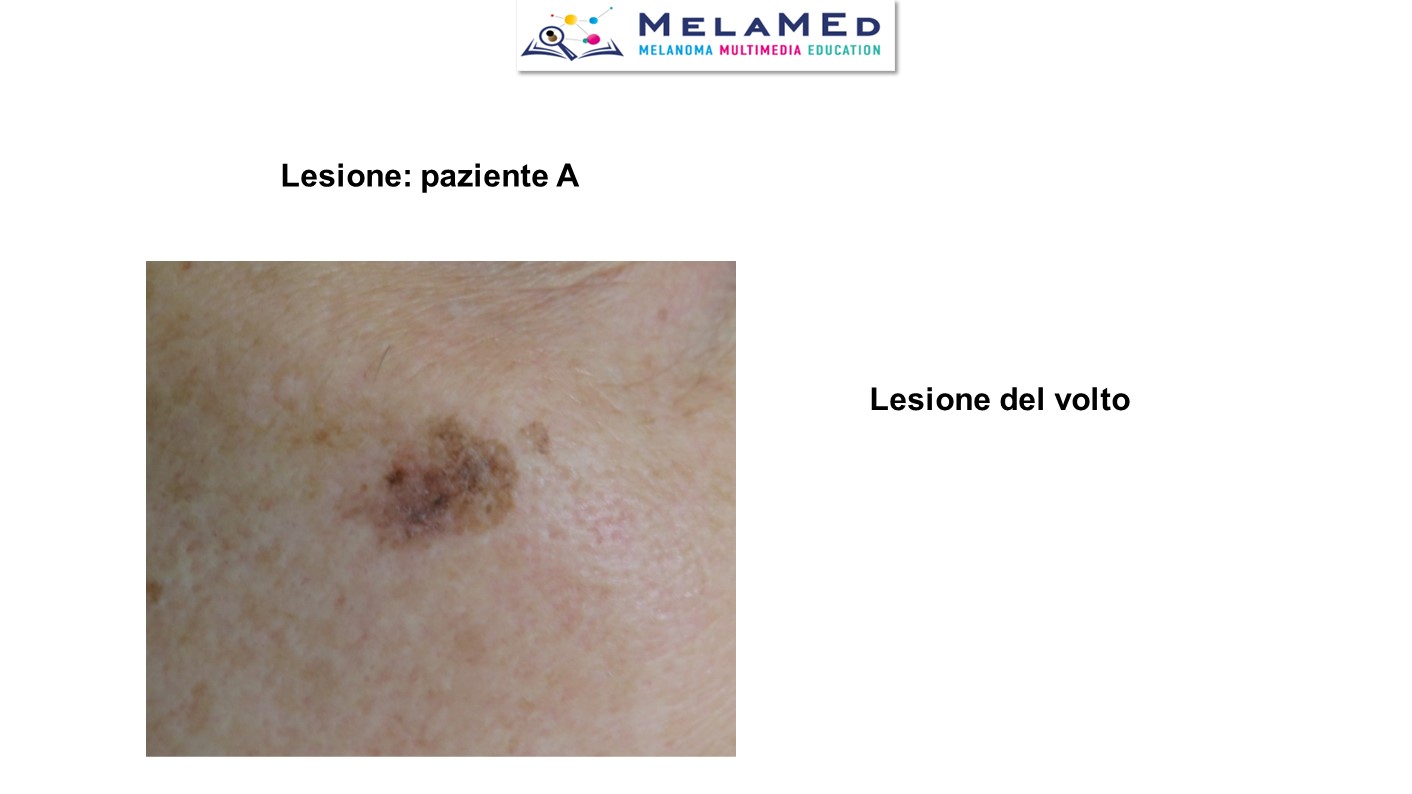 Caso clinico 4 Pizzichetta (2)